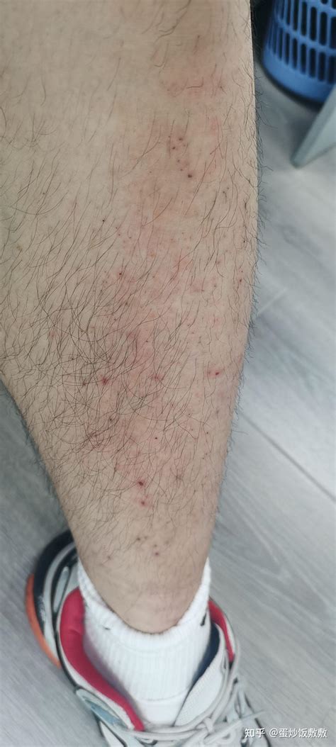 夏天腿上长了很多痘还泛红，不时的很痒，请问这是什么情况，有治疗的的方法吗？ - 知乎
