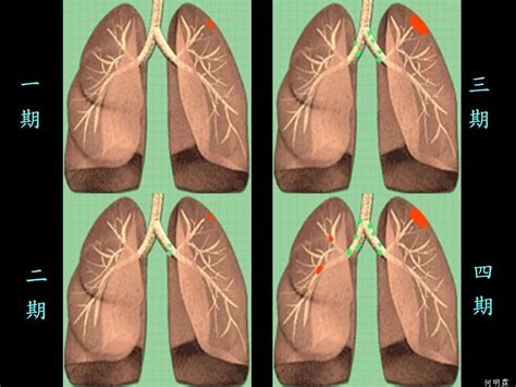 肺癌早期的五大症状需警惕 - 知乎