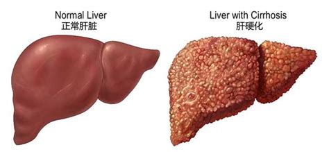 肝功能衰竭的首要症状 肝脏具有合成、解毒、代谢、分泌、生物转_新浪新闻