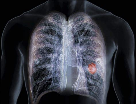 深度：肺癌早筛到底有多重要？早诊早治5年生存率可提高10倍 - 知乎