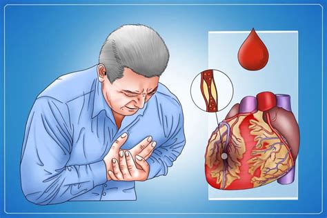 心肌梗塞的症状图片-心肌梗塞图片大全-心肌梗塞-39疾病百科