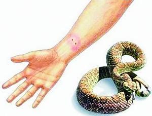 蛇咬伤的急救与护理_毒蛇咬伤_毒蛇网