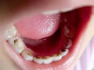 宝宝牙齿磕进牙龈图片,宝宝门牙摔歪了的图片,儿童牙龈撕裂图片_大山谷图库