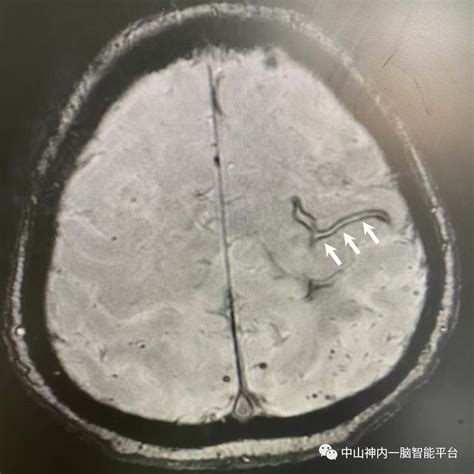 高尚病例：中枢神经系统表面铁质沉积症一例-医院汇-丁香园
