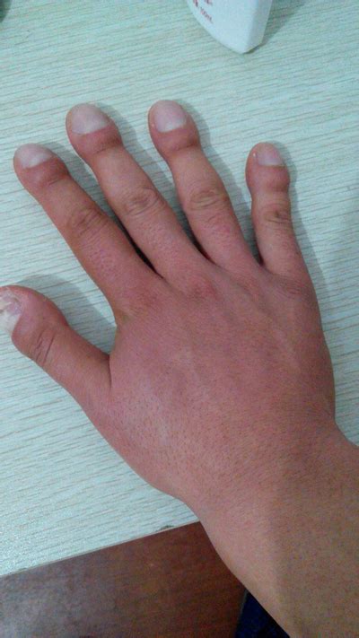 手指关节肿痛是什么原因-有来医生
