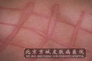 热性荨麻疹有什么症状_荨麻疹_北京京城皮肤医院(北京医保定点机构)