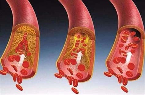 地龙蛋白主要功能与作用溶解血栓软化血管降低血粘度-补骨髓论坛