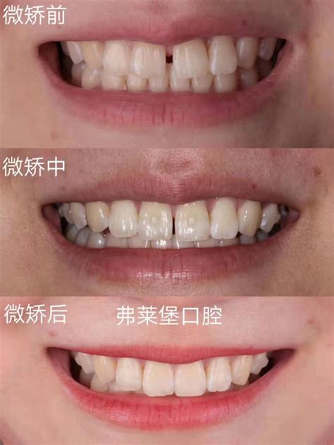 牙齿美白-牙齿美学中心-中国高端口腔服务新锐-天涯咫尺口腔