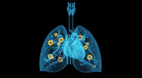 肺癌的详细症状与体征