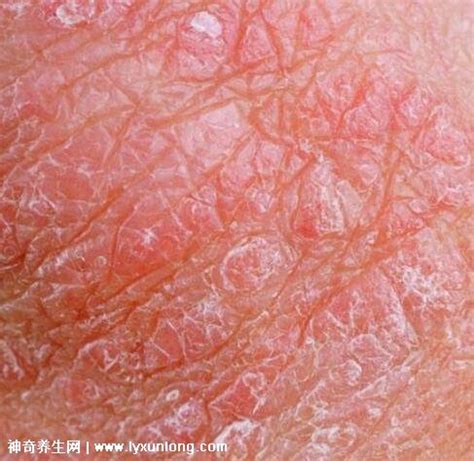 男性阴囊湿疹图片和症状图片，长小红疹剧烈瘙痒会糜烂渗液 — 神奇养生网