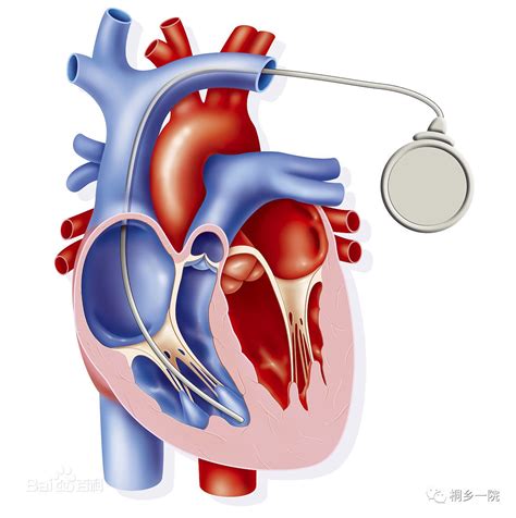 心脏起搏系统的构成、起搏器的类型及其表达方式_电极