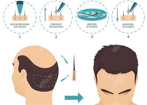 迈出治疗毛发再生第一步 新生命干细胞公司培养出“毛囊干细胞”_伍明俊_头发_博士