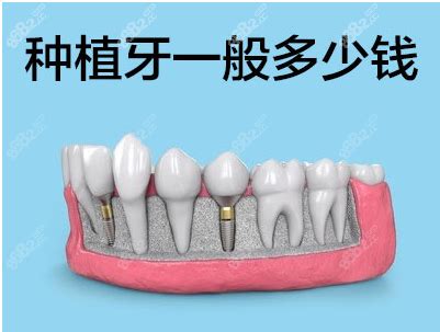 老年人全口种植牙价格表,含老人满口种植牙/种一口牙费用,牙齿修复-8682赴韩整形网