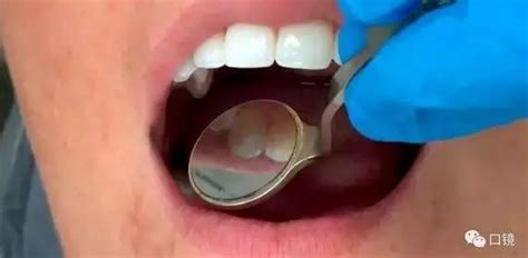 牙科口镜的使用 – 口腔医学小站