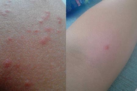 【被跳蚤咬的症状图片】【图】被跳蚤咬的症状图片欣赏 7个有效避免蚊子和蚤叮咬的措施(2)_伊秀健康|yxlady.com