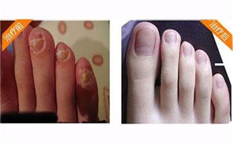 灰指甲症状表现都有哪些_灰指甲症状_大成皮肤网