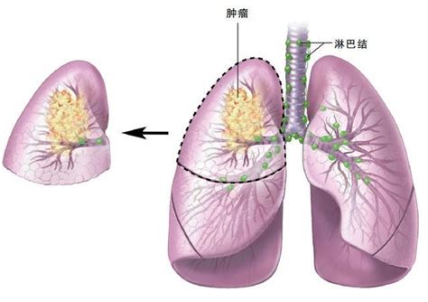 肺癌从早期发展到晚期一般需要多长时间？_肿瘤_医生在线