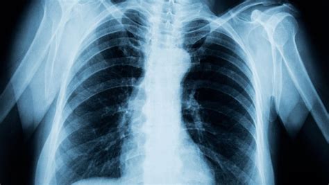 肺癌的晚期症状有哪些-百度经验