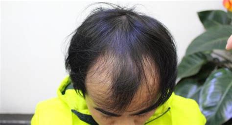 我在西安雍禾种植了头发 从光头到满头浓密只用了半年时间_西安雍禾植发植发案例 - 毛毛网