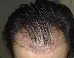 植发过程需要多长时间？植发注意事项有哪些 – 生发垂直网