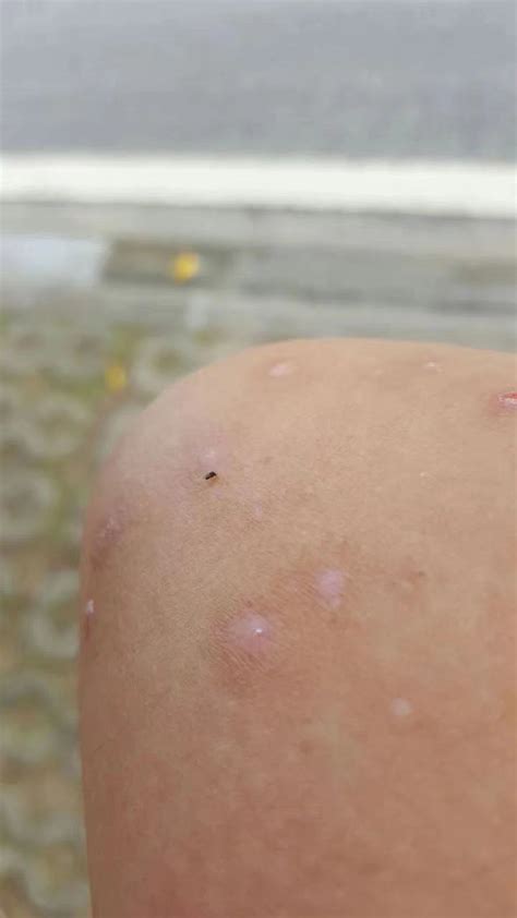 宝宝被蚊虫叮咬后，抹什么能快速止痒？ - 知乎