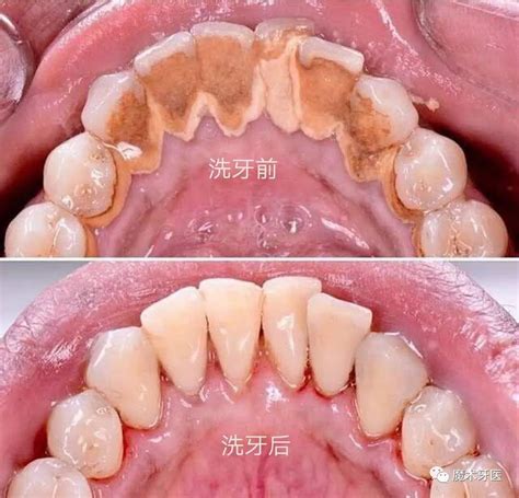 牙周炎——中国成年人后半生永远的痛|牙周炎|中国|永远|牙菌斑 ...
